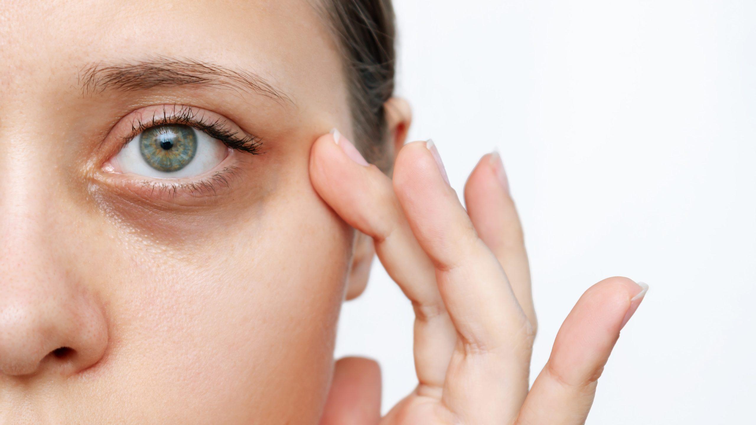 Understanding the Causes of Dark Circles and Eye​ Puffiness