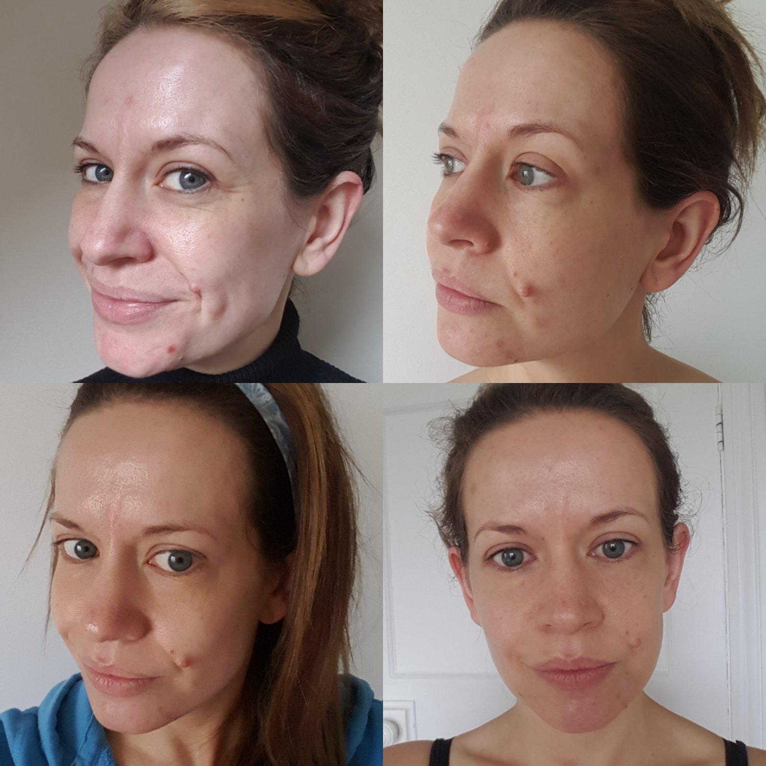 understanding​ the Science Behind Tria ‍Age-Defying Laser ‍Technology