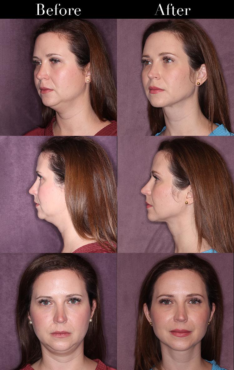 Unveiling the Science Behind Facial Contouring and Massage